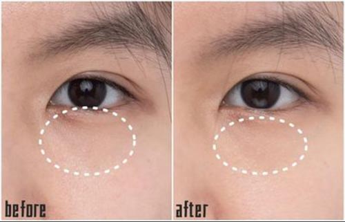 Eye Puffiness Emergency Patch